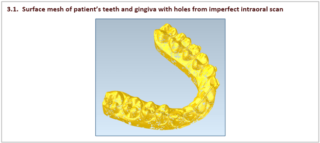 Surface mesh of patient’s teeth and gingiva with holes from imperfect intraoral scan